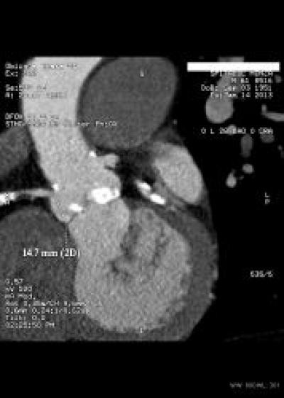 Rolul examenului Angio CT in evaluarea procedurala TAVI