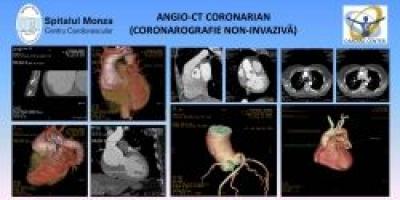 Examinarea angio-CT coronarian