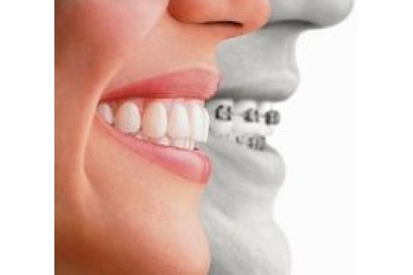 Ortodontie Sebes - dr. Mona Negura Damian - June2010_invisalign2.jpg