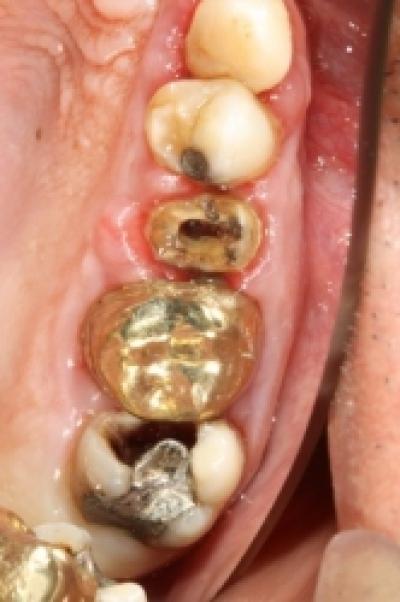 Periodontita sau boala parodontala