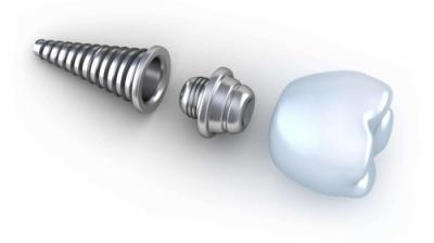 Diferența dintre coroana dentară utilizată pentru restaurarea dintelui și coroana pe implant