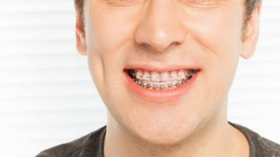 Aparatul dentar de safir – caracteristici și avantaje