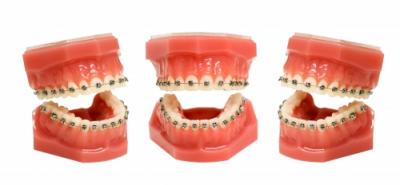 Top 4 intrebari pentru ortodont despre aparatul dentar metalic fix