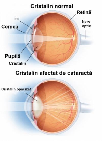Apariția și evoluția cataractei