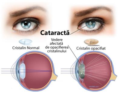 Cataracta – cauze, simptome, tratament