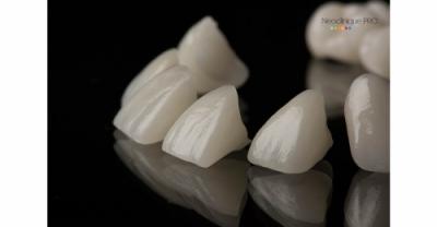Reabilitare dentara estetica cu tehnica skyn, fatete si coroane dentare cu aspect natural