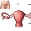 Ligatura trompelor uterine