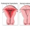 Screeningul cancerului endometrial