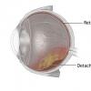 Dezlipirea de retina