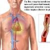 Cardiopatia ischemica: angina pectorala si infarctul miocardic