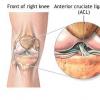 Leziunile ligamentelor incrucisate ale genunchiului