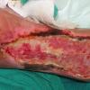 Fasceita necrozanta – infectia necrotizanta a fasciei si a tesutului subcutanat