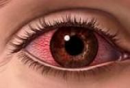 Roșeața ochilor dureri în articulații, Ce este conjunctivita?