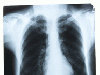 657_radiografie-plamani.gif