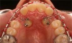 Descoperirea chirurgico-ortodontica a caninilor inclusi