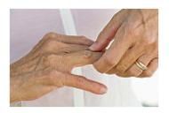 cum să tratezi artrita reumatoidă a genunchiului