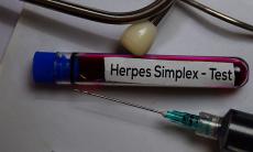 Infectia cu herpes simplex: cauze, simptome, tratament