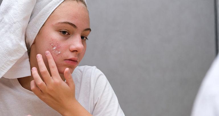 Prevenirea si tratarea tenului acneic la adolescenti