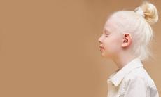 Ce complicatii pot aparea in cazul albinismului?