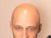 alopecia.jpg