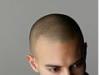 alopecie_areata.jpg
