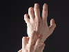 article_26_Varicela.gif