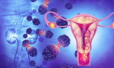 Cancerul endometrial