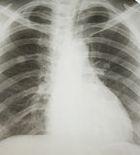 Campanie de informare cu privire la cancerul pulmonar