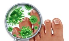 Ciuperca piciorului: 5 reguli pentru a evita infectia