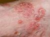 eczema_afectiune_cutanata.jpg