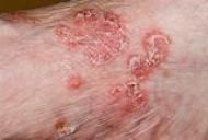 eczema durerii articulare durere la gleznă când mersul cauzează