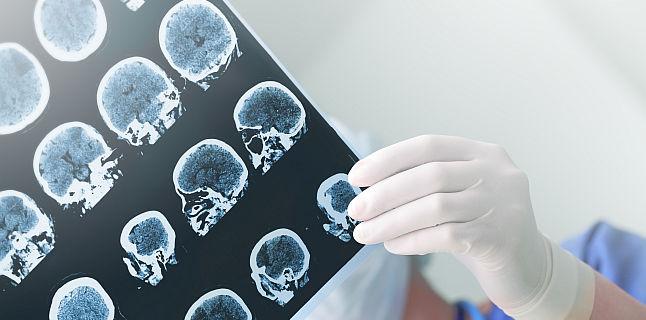 Ce ar trebui sa stii despre epilepsia dobandita in copilarie