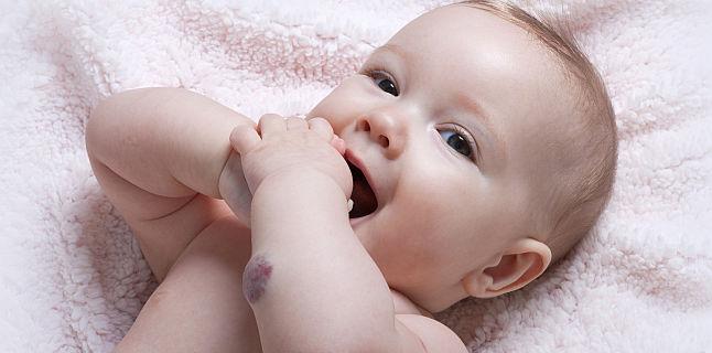 Ce trebuie sa stim despre hemangiomul infantil?