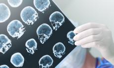 Hipoxia cerebrala sau privarea de oxigen a creierului