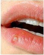 Herpesul oral (HSV-1)