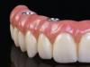 implant_dentar_fast_and_fixed.jpg