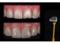 Dentcof - Incrustatiile ceramice Dentcof - Incrustatiile ceramice