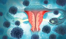 Infectia trompelor uterine (Salpingitele)