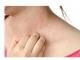 Pasi simpli pentru ingrijirea pielii afectate de psoriazis