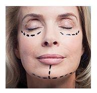 Liftingul facial (ritidectomie)