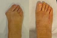 Inflamația articulației pe picior în apropierea degetului mare. Mont (inflamație) la picior