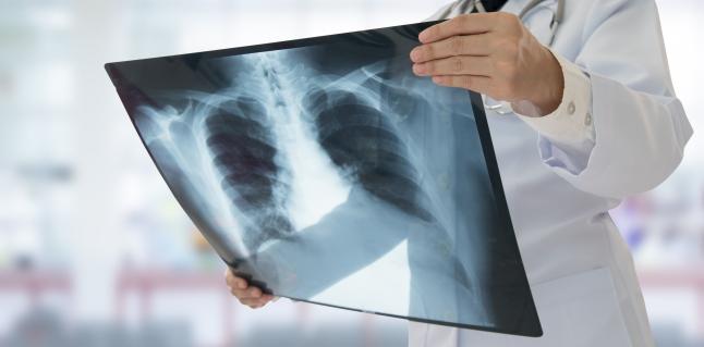 Tuberculoza (TBC): simptome si tratament 
