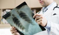 Radiografia pulmonara - cand este recomandata si de ce?