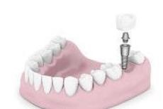 Riscuri si efecte negative in urma procedurii de implant dentar