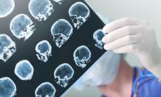 Lucruri pe care ar trebui sa le stii inainte de a face un RMN cerebral