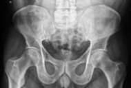 dureri normale de radiografie a articulației șoldului acolo