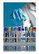 Test nou de depistare a cancerului de col uterin, lansat pe piata Test nou de depistare a cancerului de col uterin, lansat pe piata