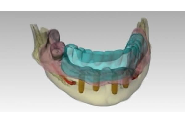 Dr.Cristian Gheorghiu - medic dentist implantolog - 2planificare_3d.jpeg