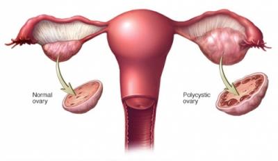 Sindromul ovarului polichistic, o afectiune pe zi ce trece mai frecventa