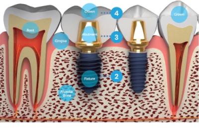 Implanturile Dentare